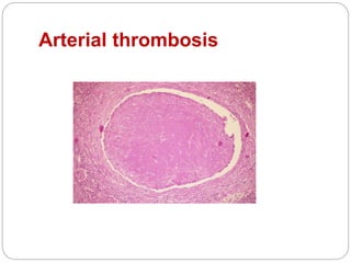 Arterial thrombosis
 