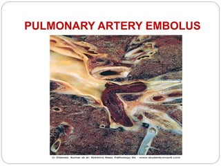 PULMONARY ARTERY EMBOLUS
 