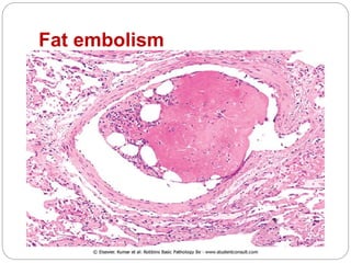 Fat embolism
 