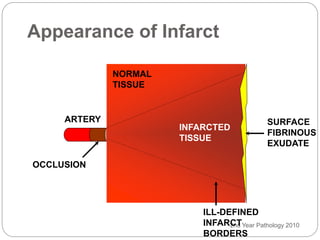2nd Year Pathology 2010
Appearance of Infarct
ARTERY
OCCLUSION
NORMAL
TISSUE
INFARCTED
TISSUE
SURFACE
FIBRINOUS
EXUDATE
ILL-DEFINED
INFARCT
BORDERS
 