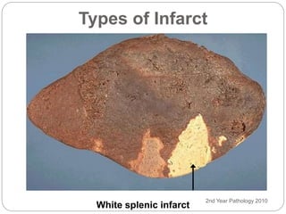 2nd Year Pathology 2010
Types of Infarct
White splenic infarct
 