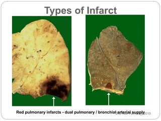 2nd Year Pathology 2010
Types of Infarct
Red pulmonary infarcts - dual pulmonary / bronchial arterial supply
 