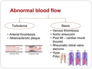 Abnormal blood flow
Turbulence Stasis
• Arterial thrombosis
• Atherosclerotic plaque
• Venous thrombosis
• Aortic aneurysm
• Post MI – cardiac mural
thrombi
• Rheumatic mitral valve
stenosis
• Hyperviscosity –
Polycythemia vera
 