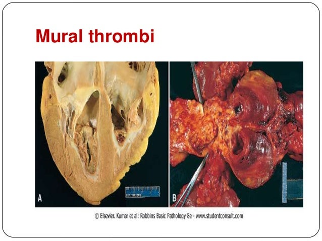 Thrombosis Embolism And Infarction Thrombosis Embolism And Infarction