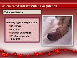Disseminated Intravascular Coagulation
Bleeding signs and symptoms
Petechiae
Purpura
Arterial line oozing
Venipuncture site
bleeding
Clinical manifestation
 