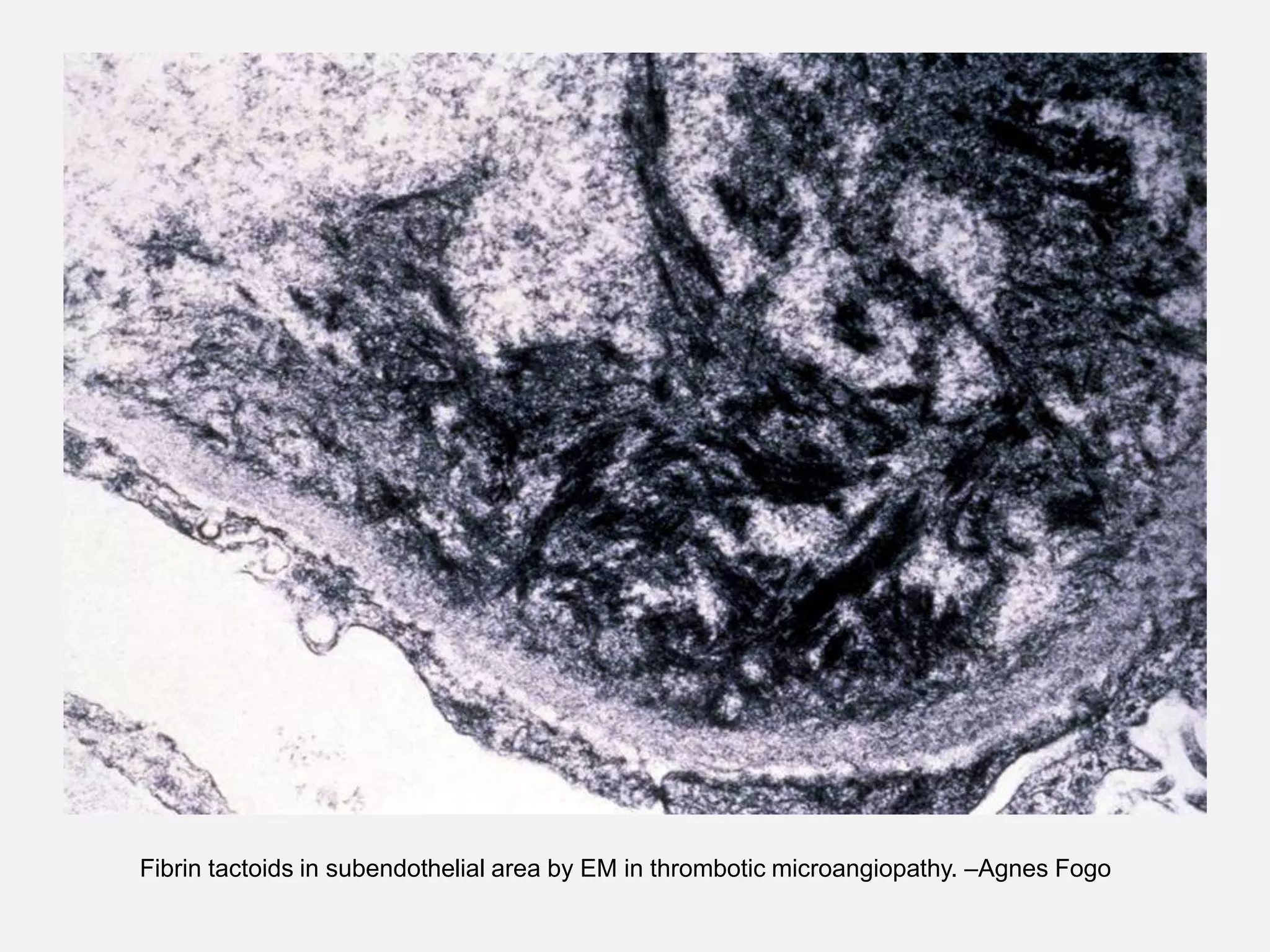 Thrombotic microangiopathies | PPT
