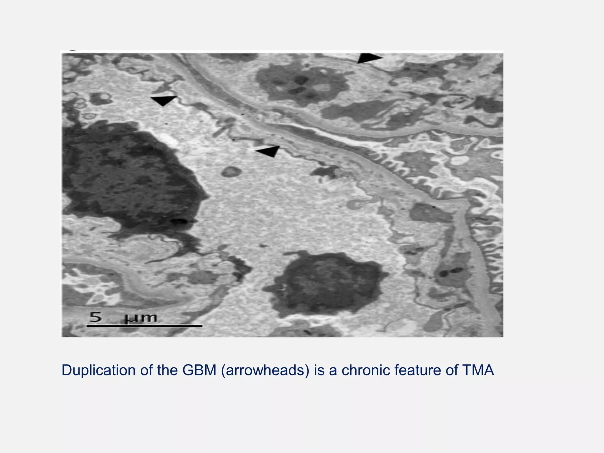 Thrombotic microangiopathies | PPT