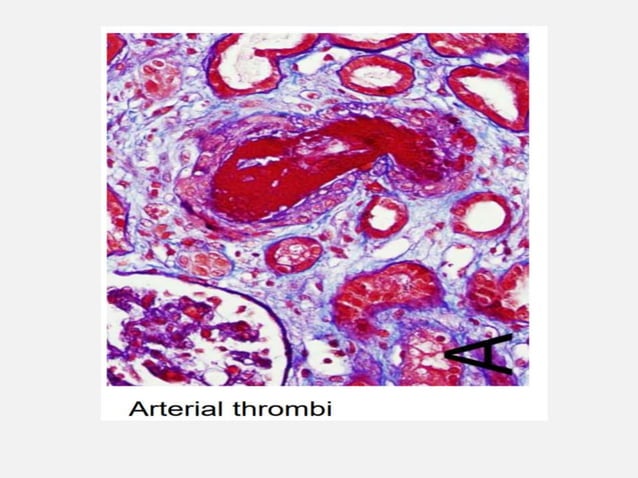 Thrombotic microangiopathies | PPT