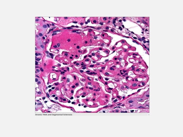 Thrombotic microangiopathies | PPT