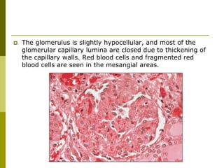  The glomerulus is slightly hypocellular, and most of the
glomerular capillary lumina are closed due to thickening of
the capillary walls. Red blood cells and fragmented red
blood cells are seen in the mesangial areas.
 