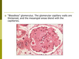  “Bloodless” glomerulus. The glomerular capillary walls are
thickened, and the mesangial areas blend with the
capillaries.
 