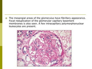  The mesangial areas of the glomerulus have fibrillary appearance.
Focal reduplication of the glomerular capillary basement
membranes is also seen. A few intracapillary polymorphonuclear
leukocytes are present.
 