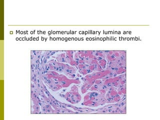  Most of the glomerular capillary lumina are
occluded by homogenous eosinophilic thrombi.
 