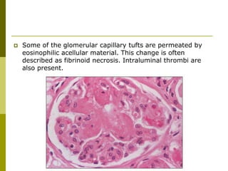  Some of the glomerular capillary tufts are permeated by
eosinophilic acellular material. This change is often
described as fibrinoid necrosis. Intraluminal thrombi are
also present.
 