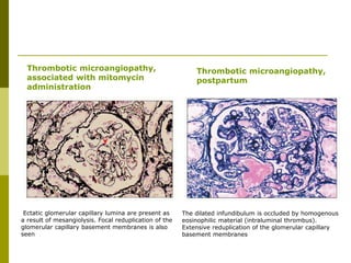 Ectatic glomerular capillary lumina are present as
a result of mesangiolysis. Focal reduplication of the
glomerular capillary basement membranes is also
seen
Thrombotic microangiopathy,
associated with mitomycin
administration
Thrombotic microangiopathy,
postpartum
The dilated infundibulum is occluded by homogenous
eosinophilic material (intraluminal thrombus).
Extensive reduplication of the glomerular capillary
basement membranes
 