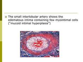  The small interlobular artery shows the
edematous intima containing few myointimal cells
(“mucoid intimal hyperplasia”)
 