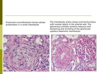 The interlobular artery shows luminal thrombus
with nuclear debris in the arterial wall. The
glomerulus exhibits ischemic features with
thickening and wrinkling of the glomerular
capillary basement membranes.
Prominent circumferential intimal cellular
proliferation in a small interlobular
 