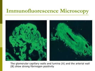 Immunofluorescence Microscopy
The glomerular capillary walls and lumina (A) and the arterial wall
(B) show strong fibrinogen positivity
 
