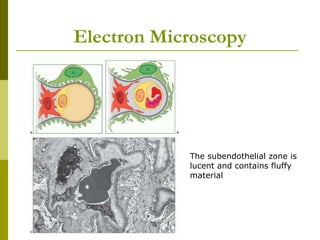Electron Microscopy
The subendothelial zone is
lucent and contains fluffy
material
 