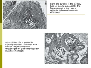 Fibrin and platelets in the capillary
loop are clearly recognizable. The
foot processes of the visceral
epithelial cells reveal moderate
effacement
Reduplication of the glomerular
capillary basement membrane with
cellular interposition.Severe
thickening of the glomerular capillary
basement membrane
 