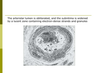 The arteriolar lumen is obliterated, and the subintima is widened
by a lucent zone containing electron-dense strands and granules
 