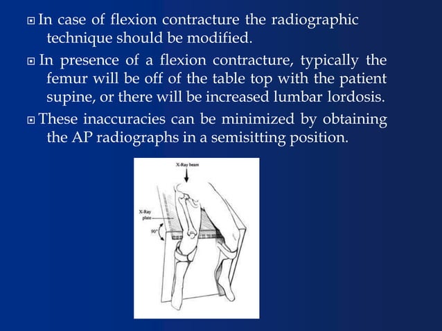 pre-operative-templating-in-total-hip-arthroplasty