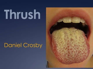 Thrush Daniel Crosby 