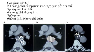 Góc picus trên CT
2: khoảng cách từ lớp niêm mạc thực quản đến đm chủ
3 phế quản chính trái
4 đường kính thực quản
5 góc picus
6 góc giữa khối u và phế quản
 