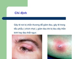 Chỉ định


Gây tê nơi bị chấn thương để giảm đau, gây tê trong
tiểu phẫu ( chích nhọt ), giảm đau khi bị đau dây thần
kinh hay đau thắt ngực
 