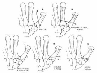 Thumb fractures | PPT