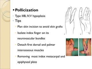 Thumb hypoplesia | PDF
