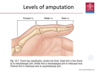 Levels of amputation
 
