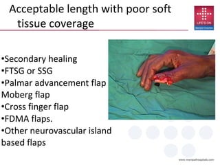 •Secondary healing
•FTSG or SSG
•Palmar advancement flap –
Moberg flap
•Cross finger flap
•FDMA flaps.
•Other neurovascular island
based flaps
Acceptable length with poor soft
tissue coverage
 