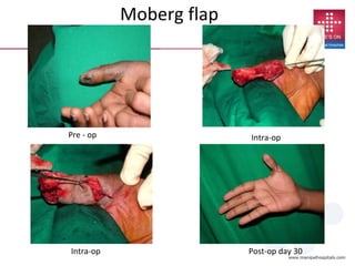 Moberg flap
Pre - op Intra-op
Intra-op Post-op day 30
 