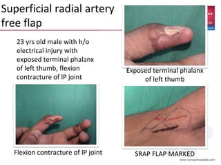 Exposed terminal phalanx
of left thumb
SRAP FLAP MARKEDFlexion contracture of lP joint
23 yrs old male with h/o
electrical injury with
exposed terminal phalanx
of left thumb, flexion
contracture of lP joint
Superficial radial artery
free flap
 