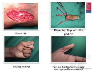 Donor site
Post op -Contracture released
and exposed bone covered
Post Op findings
Dissected flap with the
pedicle
 