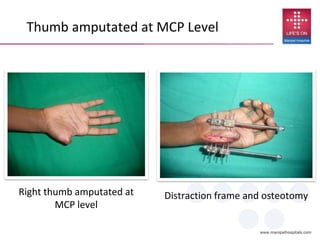 Right thumb amputated at
MCP level
Distraction frame and osteotomy
Thumb amputated at MCP Level
 
