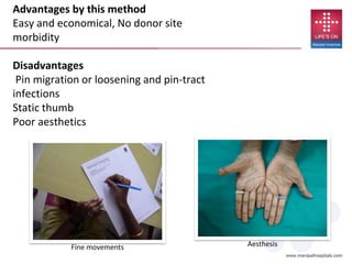 Aesthesis
Advantages by this method
Easy and economical, No donor site
morbidity
Disadvantages
Pin migration or loosening and pin-tract
infections
Static thumb
Poor aesthetics
Fine movements
 
