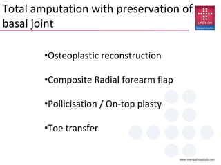 Total amputation with preservation of
basal joint
•Osteoplastic reconstruction
•Composite Radial forearm flap
•Pollicisation / On-top plasty
•Toe transfer
 