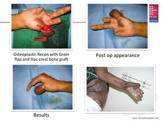 Post op appearance
Results
Osteoplastic Recon with Groin
flap and iliac crest bone graft
 
