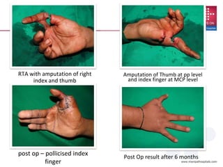 RTA with amputation of right
index and thumb
Amputation of Thumb at pp level
and index finger at MCP level
Post Op result after 6 months
post op – pollicised index
finger
 