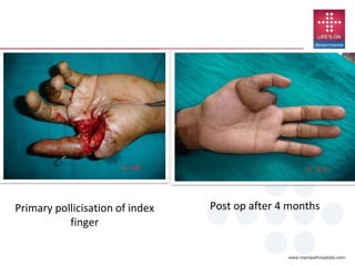 Primary pollicisation of index
finger
Post op after 4 months
 