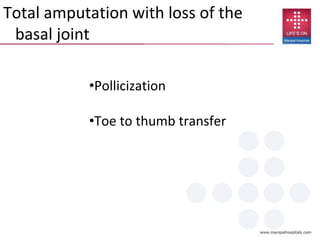 Total amputation with loss of the
basal joint
•Pollicization
•Toe to thumb transfer
 