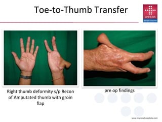 Right thumb deformity s/p Recon
of Amputated thumb with groin
flap
pre op findings
Toe-to-Thumb Transfer
 