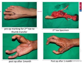 2nd toe Specimen
Post op after 1 monthpost op after 1month
pre op marking for 2nd toe to
thumb transfer
 