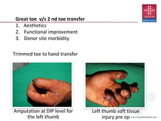 Left thumb soft tissue
injury pre op
Amputation at DIP level for
the left thumb
Trimmed toe to hand transfer
Great toe v/s 2 nd toe transfer
1. Aesthetics
2. Functional improvement
3. Donor site morbidity
 