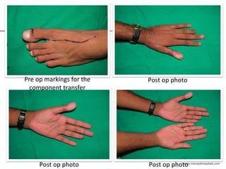 Post op photo Post op photo
Pre op markings for the
component transfer
Post op photo
 