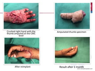Crushed right hand with the
thumb amputed at the CMC
level
Amputated thumb specimen
After reimplant Result after 1 month
 