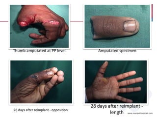 Amputated specimenThumb amputated at PP level
28 days after reimplant - opposition
28 days after reimplant -
length
 