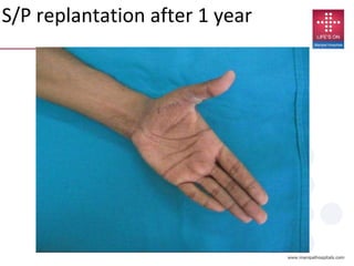 S/P replantation after 1 year
 